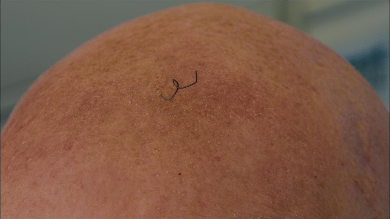 Extreme close-up of a scalp with one new curling hair